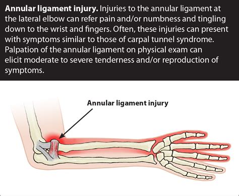 elbow annular ligament tear symptoms